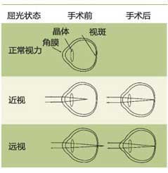 近视人口_重庆近视防治中心介绍中国近视现状