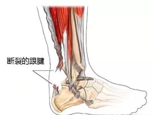 脚背筋基本断了,肌腱断了,还断了血管,并且多处骨折可以构成10级伤残吗
