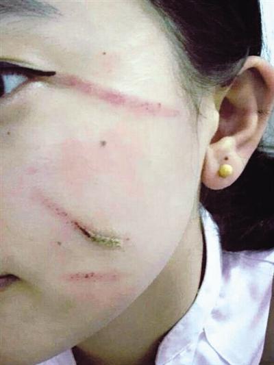 被打女乘务员拍下的照片显示，殴打她的乘客在她脸上留下了多道抓痕。 人民日报微博截图