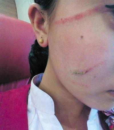 被打女乘务员拍下的照片显示，殴打她的乘客在她脸上留下了多道抓痕。 人民日报微博截图