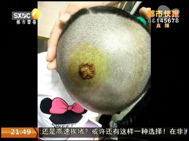 孩子家长强行拔掉咬人蜱虫 致女童头部破溃感
