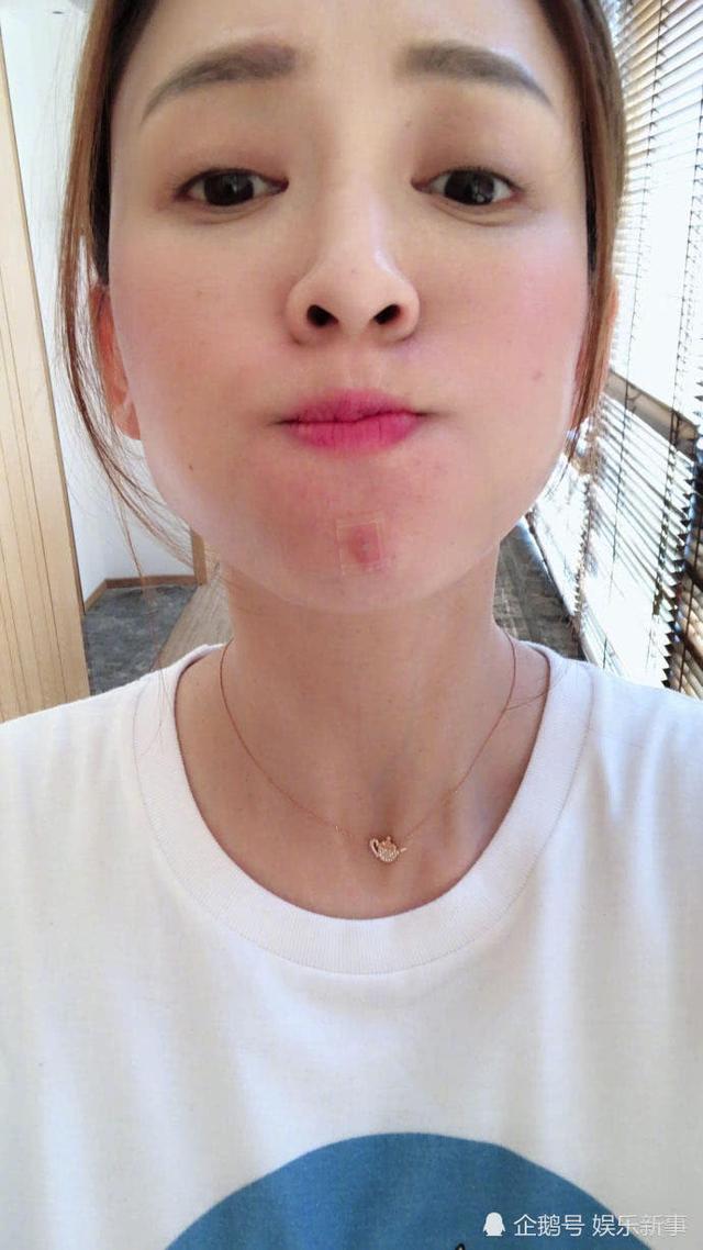 陈乔恩晒痘痘照自黑 粉丝调侃“美得冒泡”