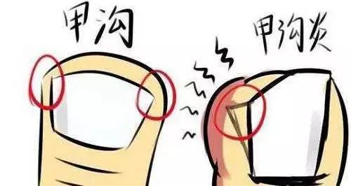 甲沟炎是什么症状怎么形成的 149235474.jpg