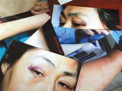 昨日，照片显示律师眼角、手臂等处有伤痕。当事律师称，4月2日她在通州法院遭法官法警殴打。 新京报记者 左燕燕 摄