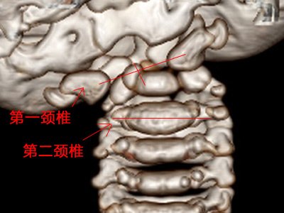 手术前的三维ct显示第一第二颈椎发育畸形且严重脱位手术后的三维ct