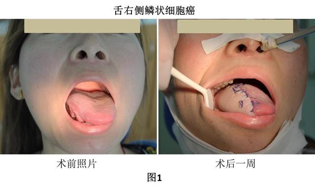 为一名舌癌患者实施了舌颈联合根治并同期前臂皮瓣游离移植修复手术