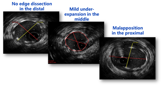 省人民医院医师获全球心血管病介入会议最佳挑
