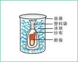 2017年美女六肖图:春节将至 骨伤科医师提醒您注意防止手外伤