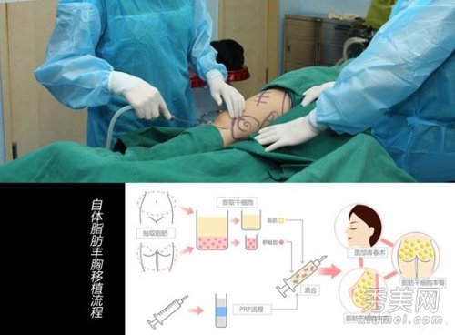 "小杨幂"自曝隆胸全过程