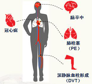 上班族们请注意 经常久坐不动当心血栓来袭!