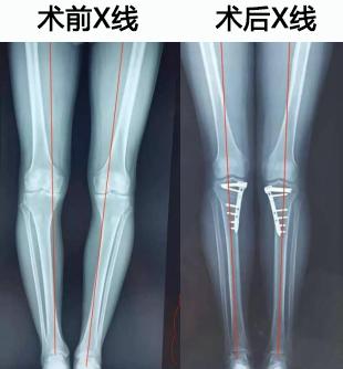 脆弱的膝盖 日常生活中如何保护膝关节?