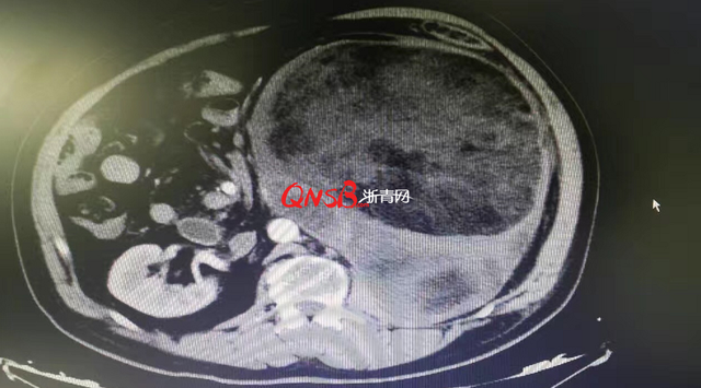 杭州六旬男子肚子变大 结果长了个12斤重肿瘤