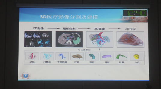 曹利平教授——《基于三维重建的胰腺癌术前精准评估》