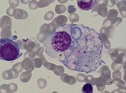 海宁有多个孩子感染EB病毒 严重者可引发脑膜炎_大浙网_腾讯网