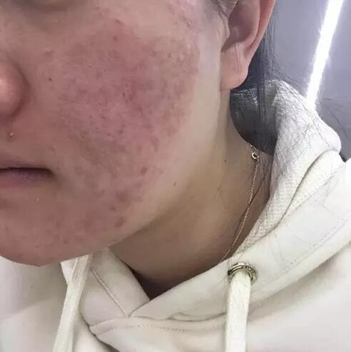 姑娘花7万治2年换回烂脸 自拍至少要修图10分