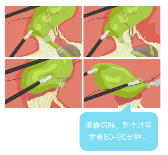 不开膛破肚,看腹腔镜下如何做胆囊切除手术!_大浙网_腾讯网