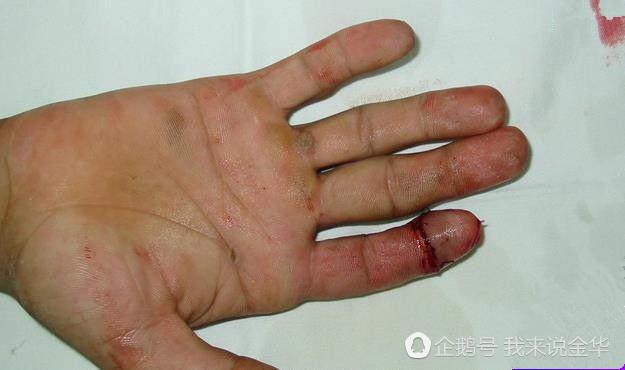 金华男子为表戒赌决心 一年内连续切断两根手指