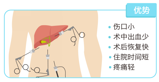 不开膛破肚，看腹腔镜下如何做胆囊切除手术!_大浙网_腾讯网