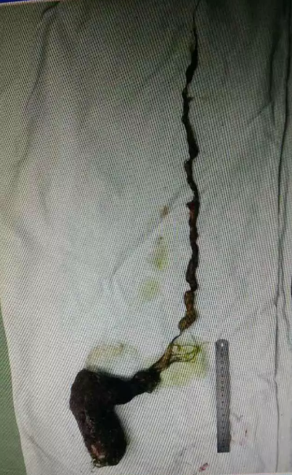 金华<em>12岁</em>少女胃里长满<em>头发</em> 每晚睡前吃几根_大