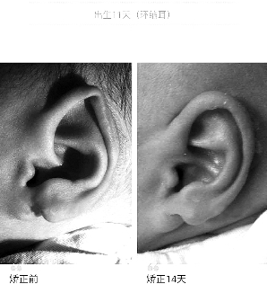 浙江一宝宝耳朵被说有特色 被诊断为耳廓畸形