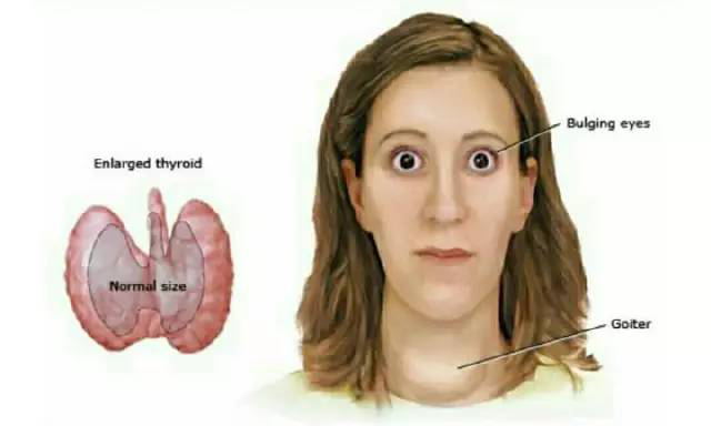 帮帮我谢谢大家甲亢面容甲亢症状甲亢图片甲亢好治吗甲亢甲亢是什么病