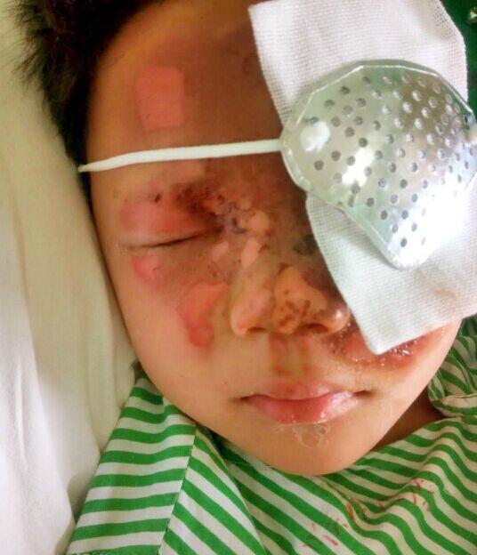 台州9岁男孩被劣质烟花炸伤左眼 网友接力献爱心