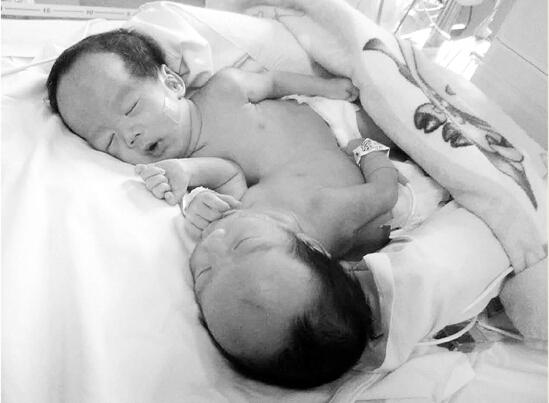 打工夫妻生下一对连体婴 手术费用至少30万_大浙网_腾讯网