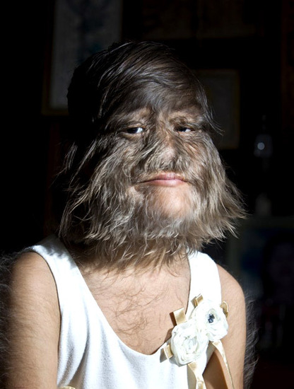 泰国女孩患罕见"多毛症" 脸上身上布满长毛