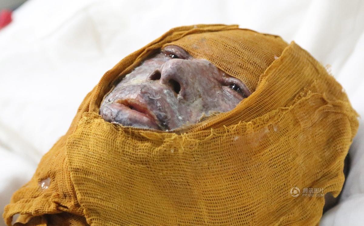 湖南派出所副所长救纵火男致重度烧伤