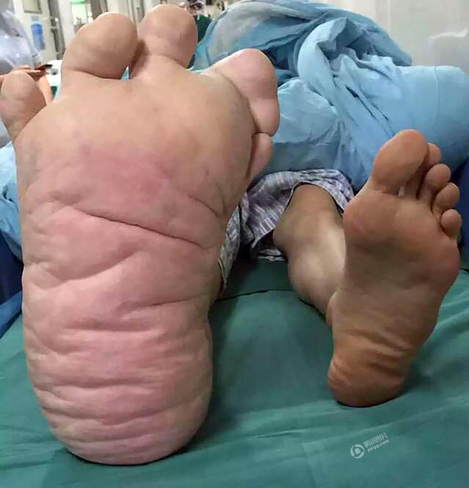 小伙患巨肢症 右脚长近40厘米
