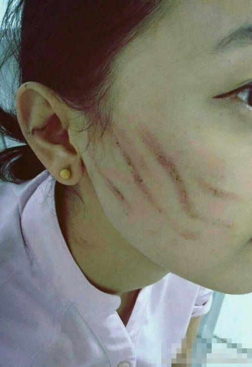 【高铁乘务员】被12名乘客殴打 脸和胳膊有多处伤口