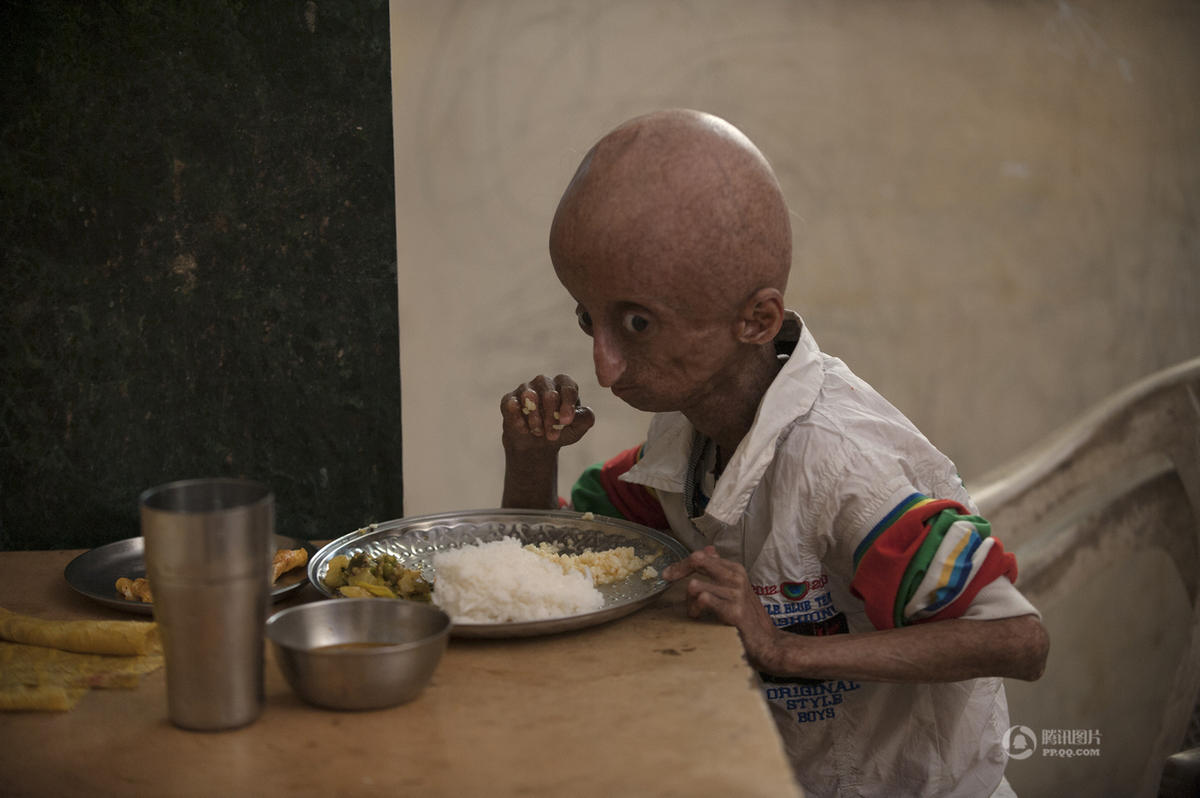 【转载】印度早衰症男孩庆祝15岁生日