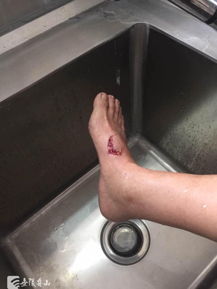 舟山"疯狗王"一次咬伤47人 最后被石头木棍击倒