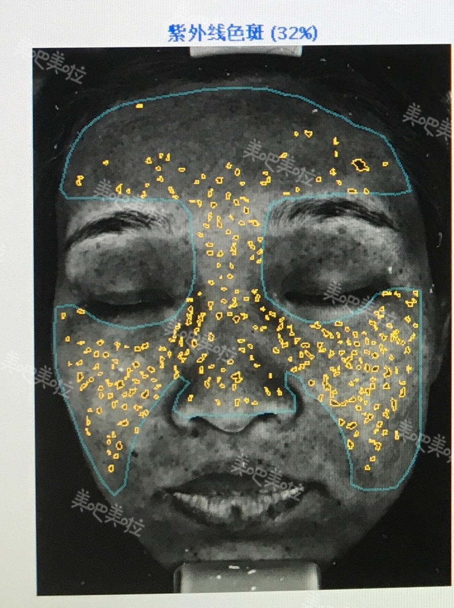 女孩不防晒检测仪下色斑触目惊心