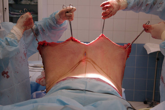 大肚子女孩手术图片