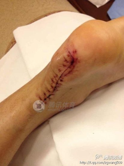 刘翔拆线伤口不忍睹 脚踝取出巨大钙化点(图)
