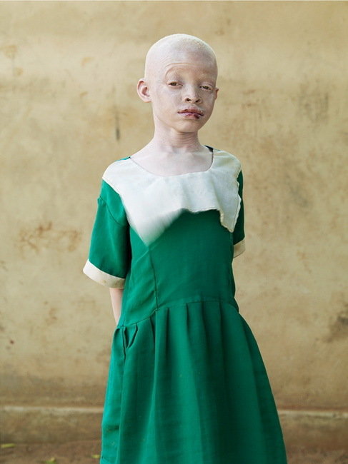 2013连州国际摄影展个展作品《白化病患》