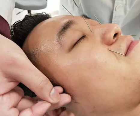 被这种变态性疾病折磨到无法呼吸 女医生在我脸上扎入5厘米深银针