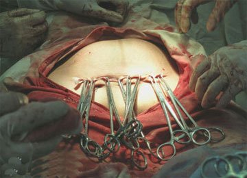 剖腹产过程是怎样的 -学路网-学习路上 有我相伴