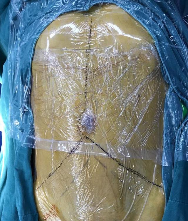 生长10kg脂肪肉瘤,重医附二院魔幻3d动态重建助力拿下后腹膜"巨无霸"