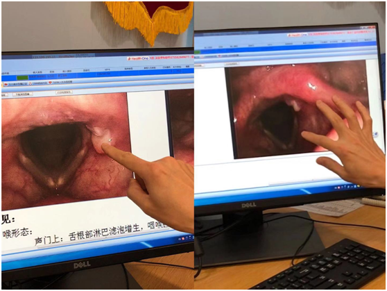 重庆仁品耳鼻喉医院又一例接触性肉芽肿完美消失