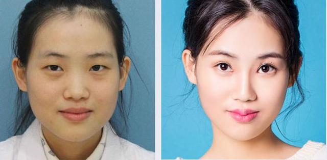重庆市医学会医学美容与美容学委员冯辉利院长面诊后指出:"小凤的面部
