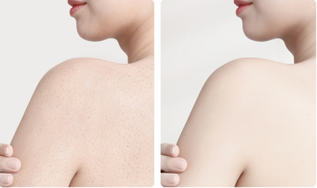 鸡皮肤打针(鸡皮肤打针用什么药) 鸡皮肤打针(鸡皮肤打针用什么药)