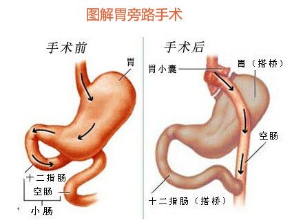 胃空肠吻合术(旁路)图片
