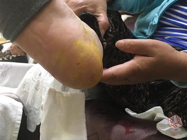 女子去洗脚店修脚修出血店方称是修掉硬皮露出肉