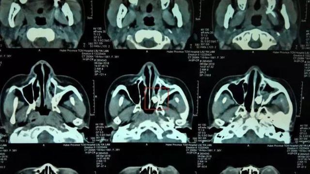 劉女士入院後的ct,紅框部分就是堵塞了上頜竇口的牙齒