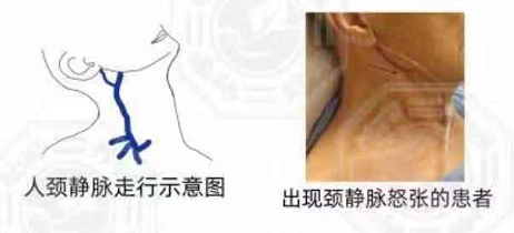 慢性心衰竭 有&ldquo;知&rdquo;才有&ldquo;治&rdquo;