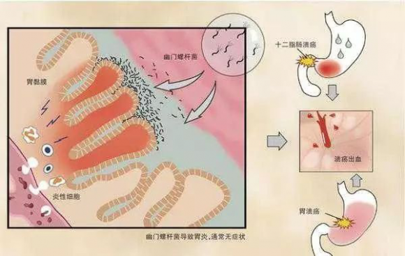 幽门螺旋杆菌绘图图片