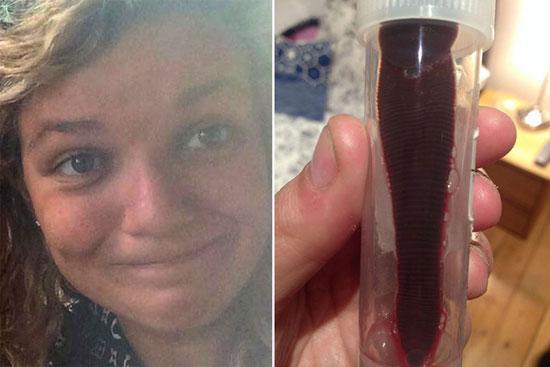 英国女子赴越游玩遇险 水蛭钻其鼻腔吸血