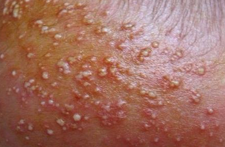 夏季皮肤护理教你一秒辨别bb长痱子的类型